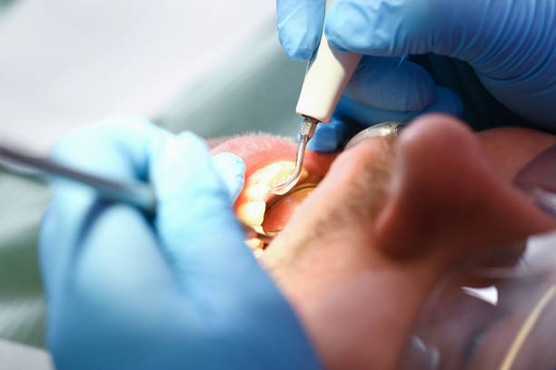 Best Emergency Tooth Extraction in Stone Mountain, GA