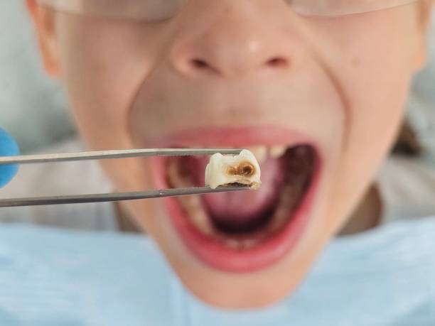 Best Emergency Root Canal Treatment in Stone Mountain, GA